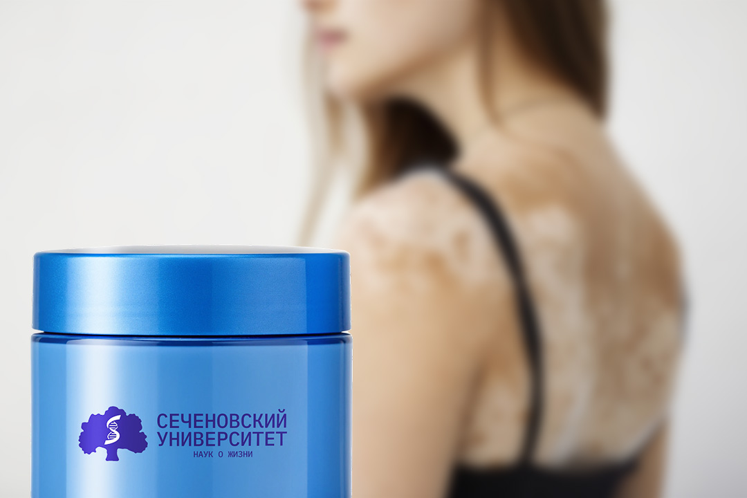  В Сеченовском Университете создали крем от витилиго 
