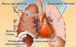 Астматический синдром что это. 7984d429b64e127d5b4b18e115195fc6. Астматический синдром что это фото. Астматический синдром что это-7984d429b64e127d5b4b18e115195fc6. картинка Астматический синдром что это. картинка 7984d429b64e127d5b4b18e115195fc6.