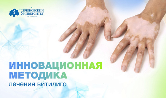  В Сеченовском Университете разработали новую методику лечения витилиго 