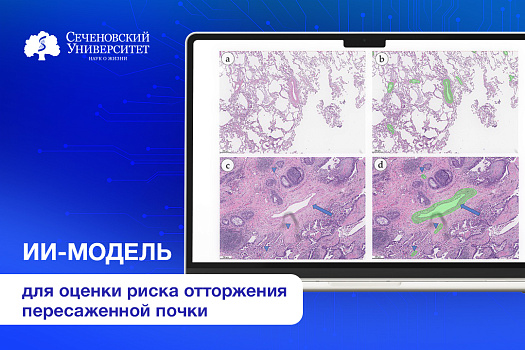  Сеченовский Университет и билайн создали совместное решение для оценки отторжения пересаженной почки с помощью ИИ 